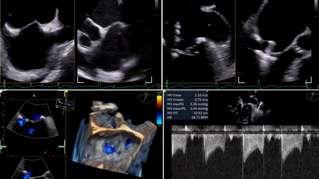 Rapid-fire - Challenging mitral procedures - Part 1
