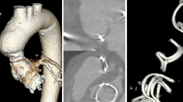 Rapid-fire - Challenging TAVI procedures - Part 4