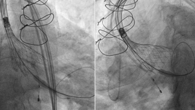 Rapid-fire - Nightmares in the cathlab - Part 1