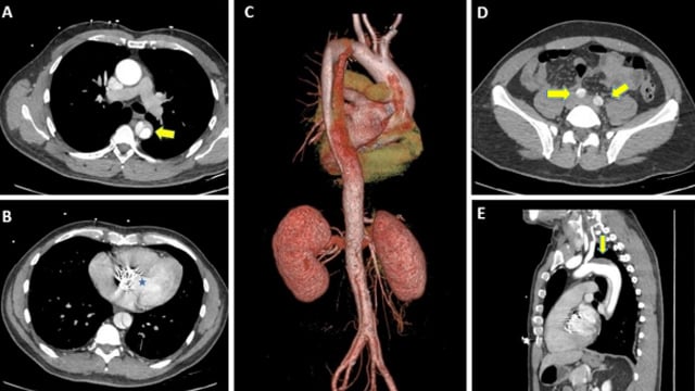 Rapid-fire - TAVI complications - Part 2
