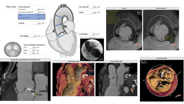 Rapid-fire - TAVI complications - Part 3