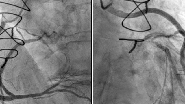 Rare complications of structural intervention