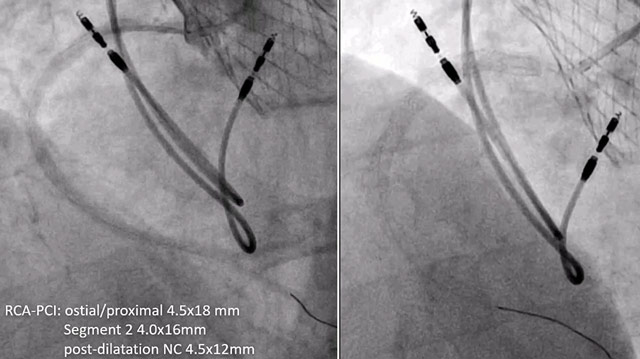 TAVI and beyond: tackling coronary challenges