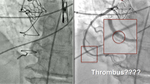 TAVI - Coronary complications