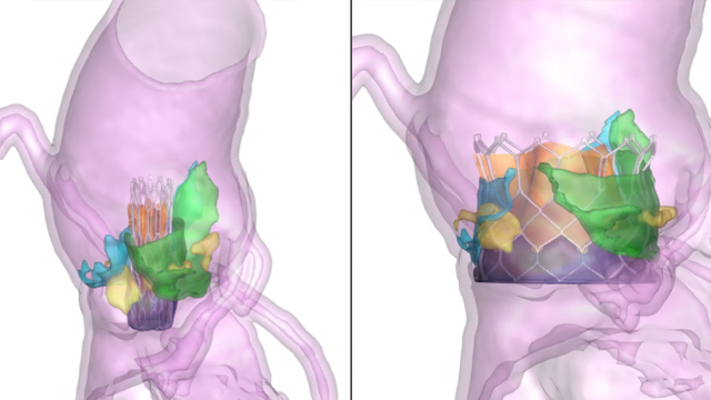 TAVI in bicuspid anatomy - Part 2
