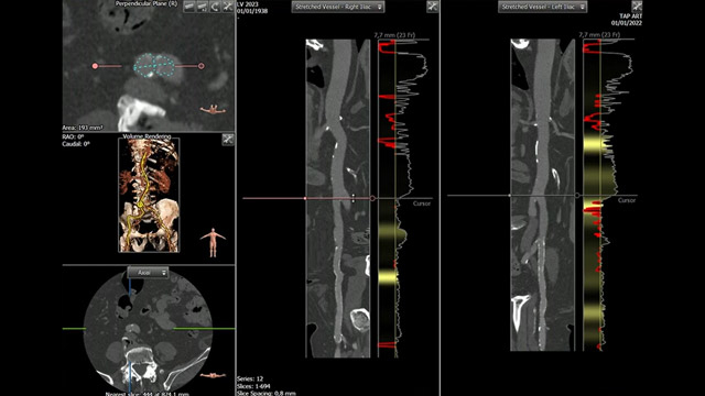 TAVI step by step