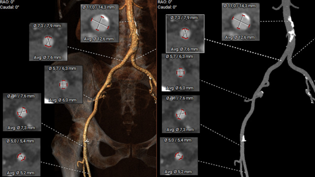 TAVI - Vascular complications