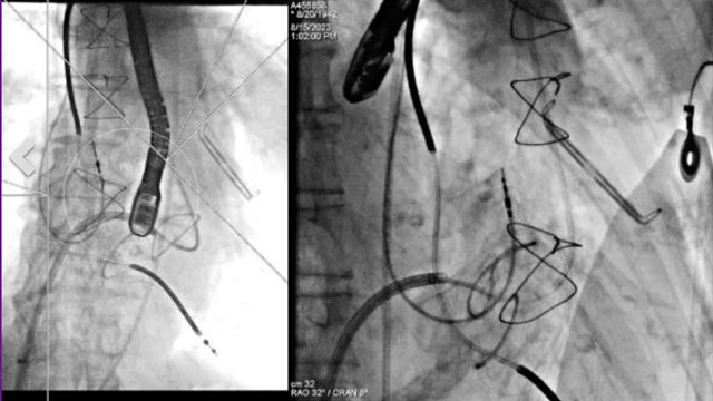TAVI with challenging femoral access