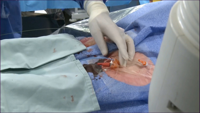 The catheter-based treatment revolution is just getting started