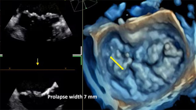 Transcatheter mitral valve intervention - 20 years on - LIVE case