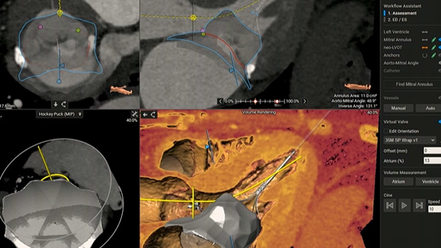 Transcatheter mitral valve replacement - The wait will be worth it
