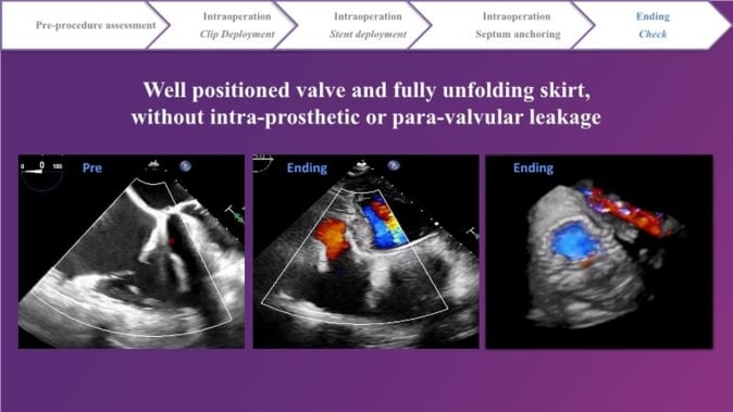 Tricuspid Late-Breaking Trials