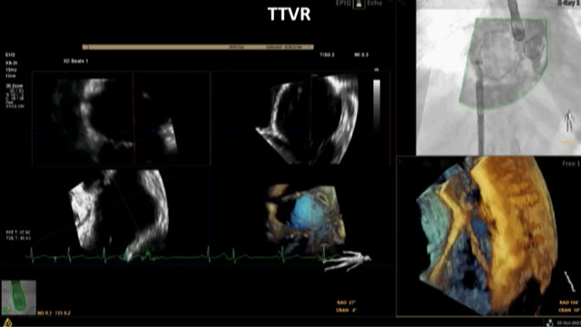 Tricuspid valve intervention in complex scenarios - Patient and procedural optimisation