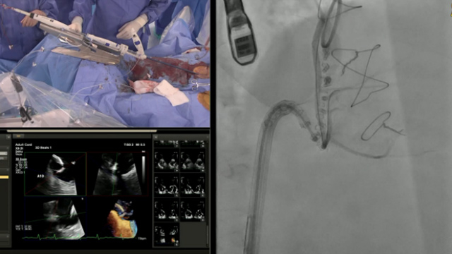 Tricuspid valve interventions in complex scenarios