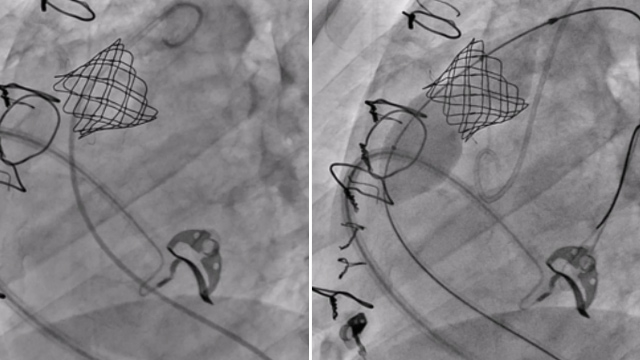 Valve in valve - Pulmonary - Part 3