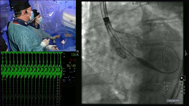 Valve performance and durability - Main considerations in selecting the right TAVI valve