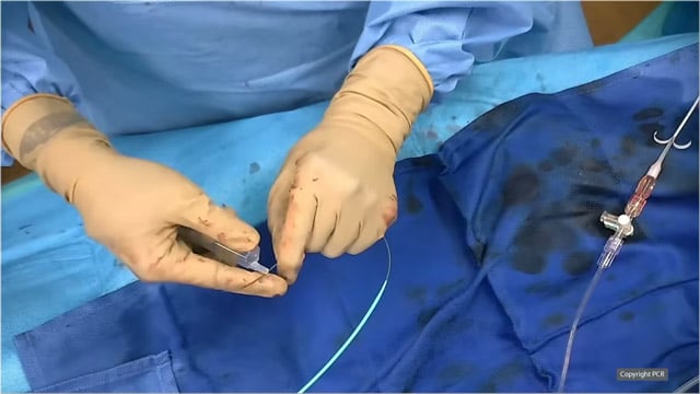 TAVI in small annulus and CAD