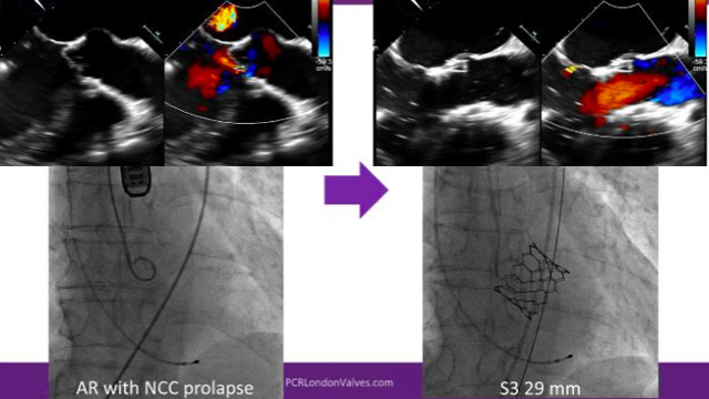 TAVI failure - Mechanisms and management