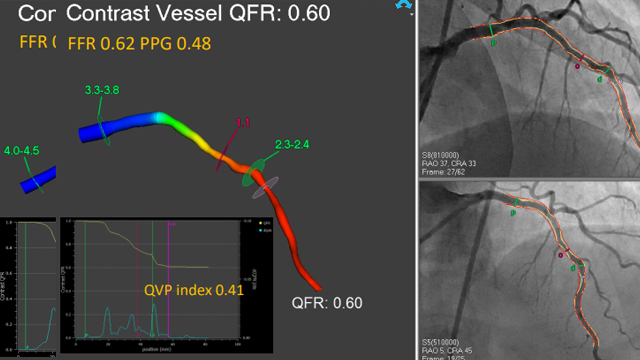 Cutting-edge abstracts on coronary and valvular interventions