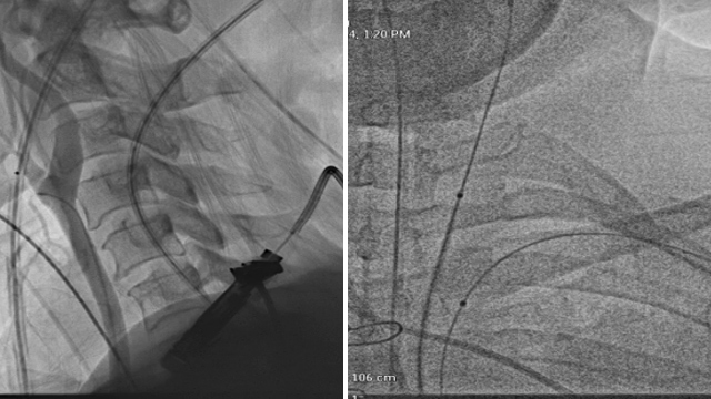 Best clinical cases: Stent degloving, valve defects, and calcified lesions
