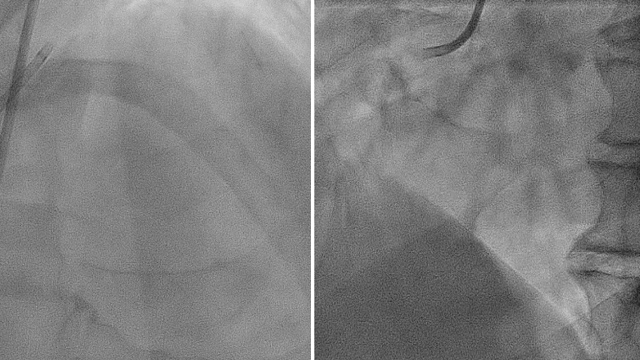 Navigating the challenges of calcified lesions