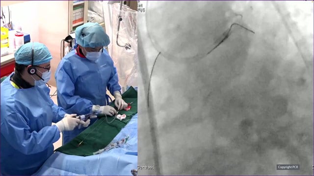 Complex left main bifurcation PCI - LIVE case