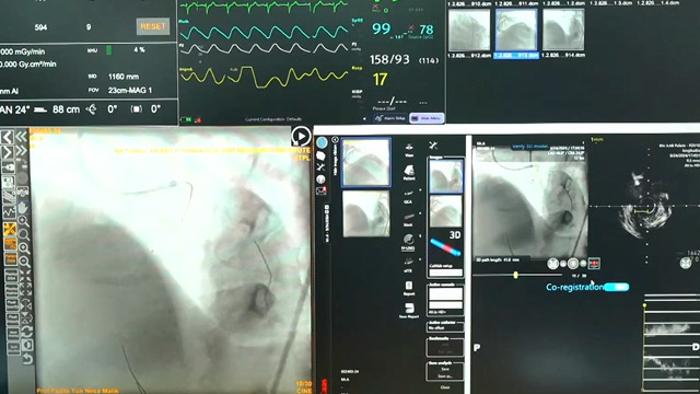 Image-guided PCI of distal left main disease