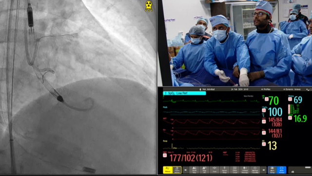 Latest paradigm changes in mechanical circulatory support for high-risk PCI and AMI cardiogenic shock
