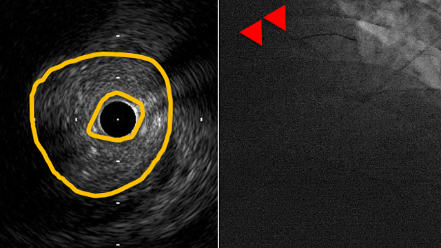 Expert strategies for high-risk left main procedures