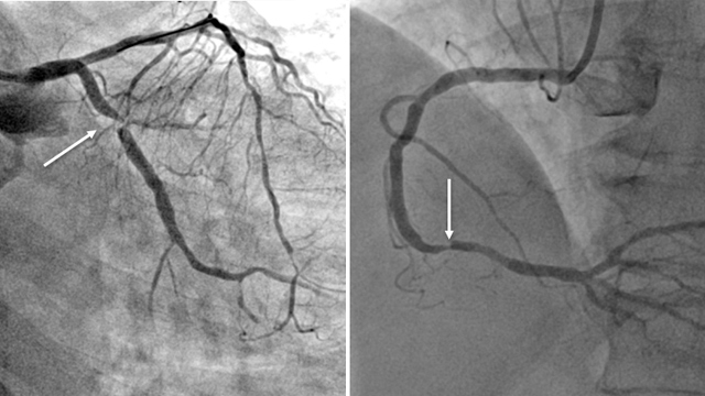 NSTEMI case studies: Innovative solutions for calcified lesions and coronary leaks