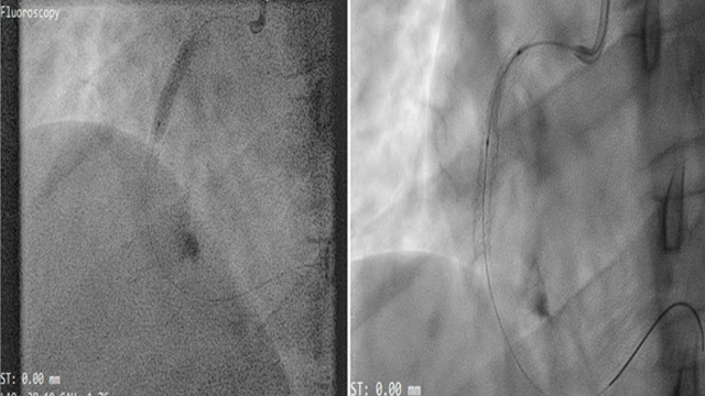 Complex NSTEMI interventions: Bifurcation and calcification management strategies