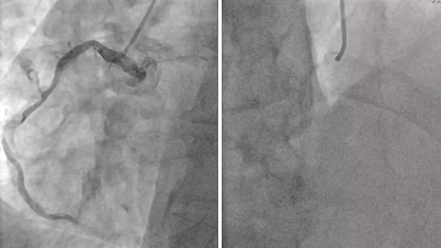 Synergistic use of calcium modification devices for treatment of severely calcified lesion