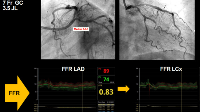 The role of coronary physiology in daily practice: how it changes your PCI strategy