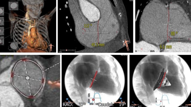 Acute and chronic right ventricular failure: focus on the weak link