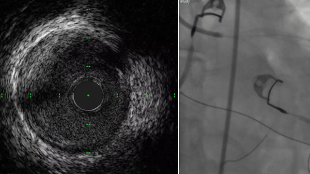 Acute coronary syndromes: keep an eye open for unusual presentations