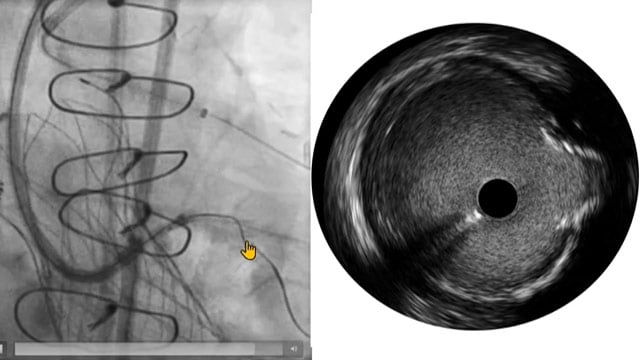 Antegrade CTO PCI: how to develop a consistent and systematic strategy ?
