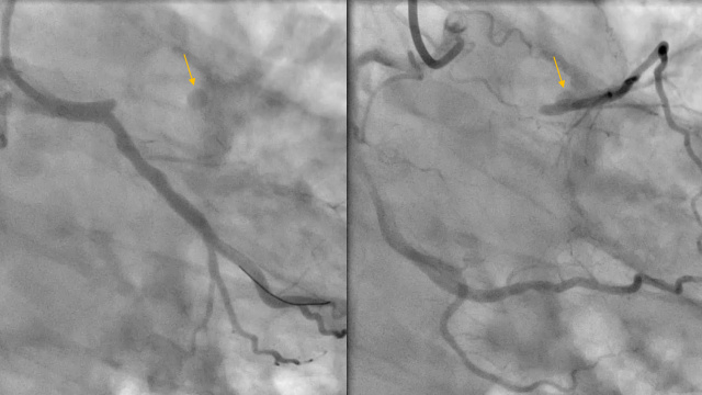 Antegrade CTO - LIVE case