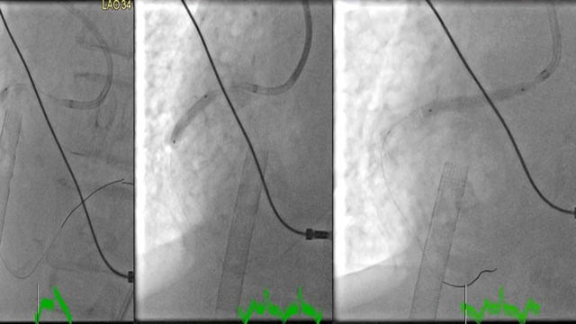 Antiplatelet de-escalation after complex PCI