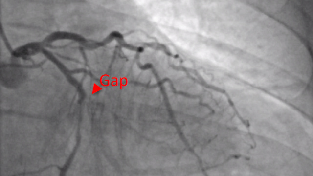Bifurcation lesion, interactive case discussion