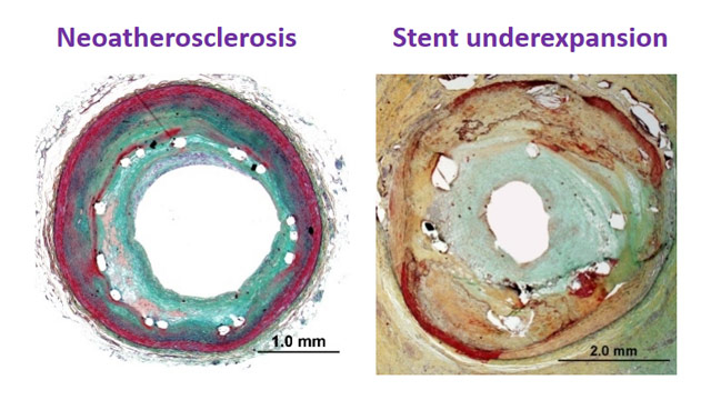 Bridging perspectives: bifurcation lesions - A global case exploration