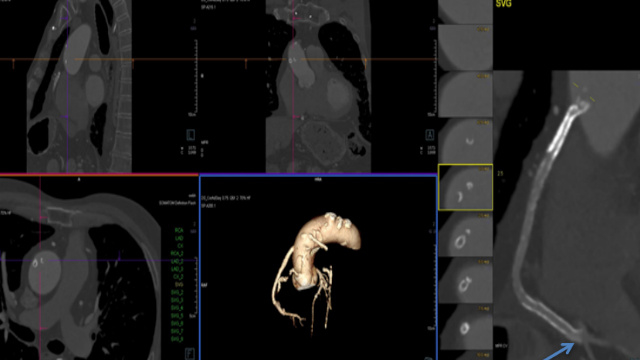 Calcified coronary lesions: procedural techniques - Part 1