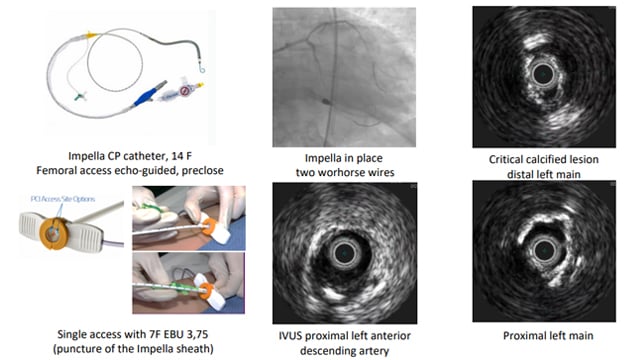 Calcified coronary lesions: procedural techniques