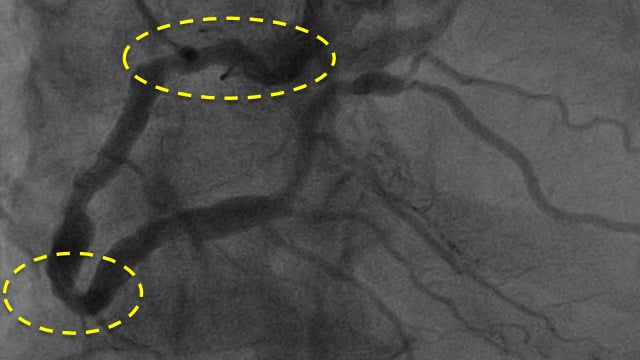 Calcified left main PCI strategies