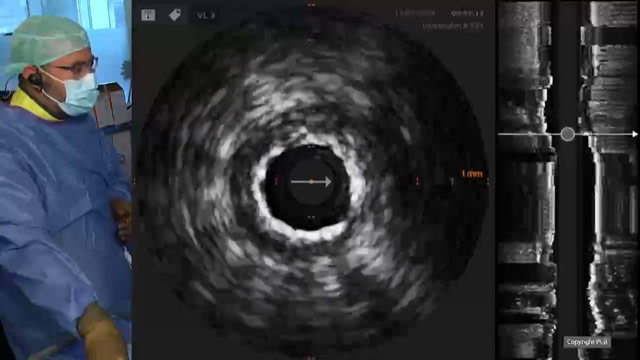 Calcified lesions: LIVE Educational Case