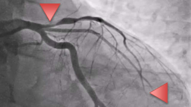 Cardiogenic shock in women : different cause, different treatment