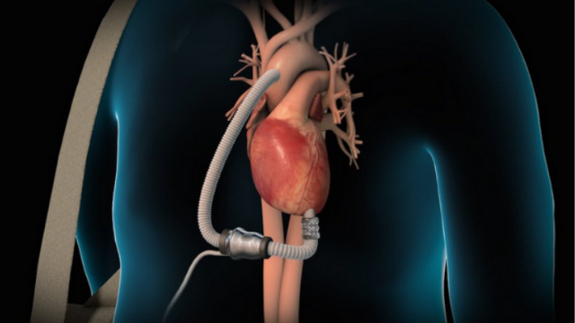 Cardiovascular intervention for chronic heart failure: where do we stand?