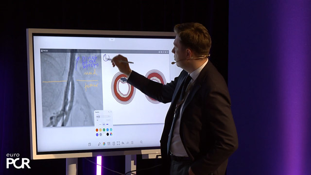 Case closed: understanding the steps of vascular access and closure in TAVI patients