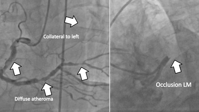 Challenges and complications in STEMI: resuscitated cardiac arrest, left ventricular free wall rupture & more!