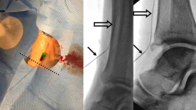Challenges in below-the-knee