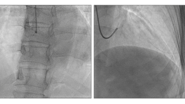 Challenges in the treatment of STEMI: unexpected findings and smart solutions